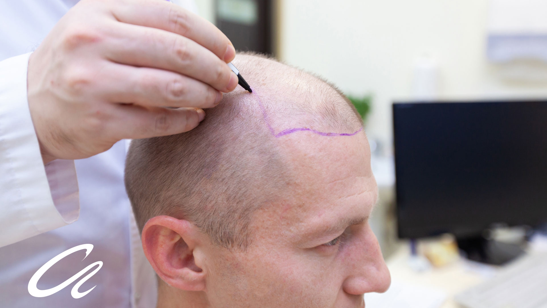 hair loss treatmnets