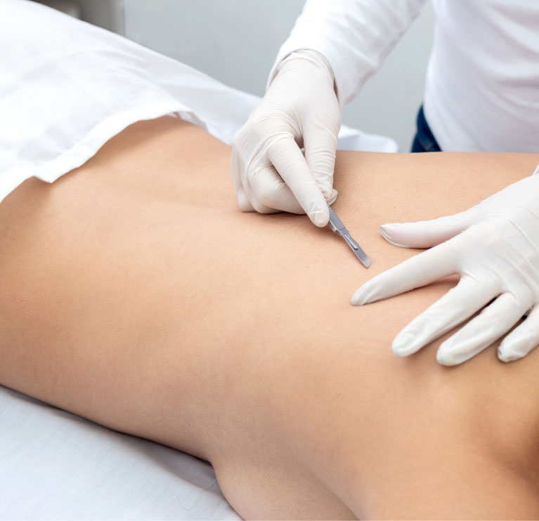 mishawaka woman receiving dermaplaning to back