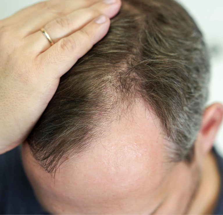 mishawaka man showing receeding hairline