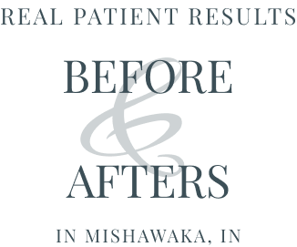 Real patient before and afters in Mishawaka, IN