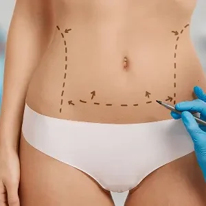 Liposuction in Indiana 300x300