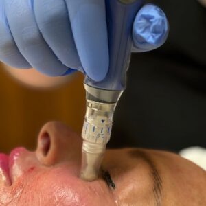 products microneedling 65200 1729864894 1280 1280 jpg