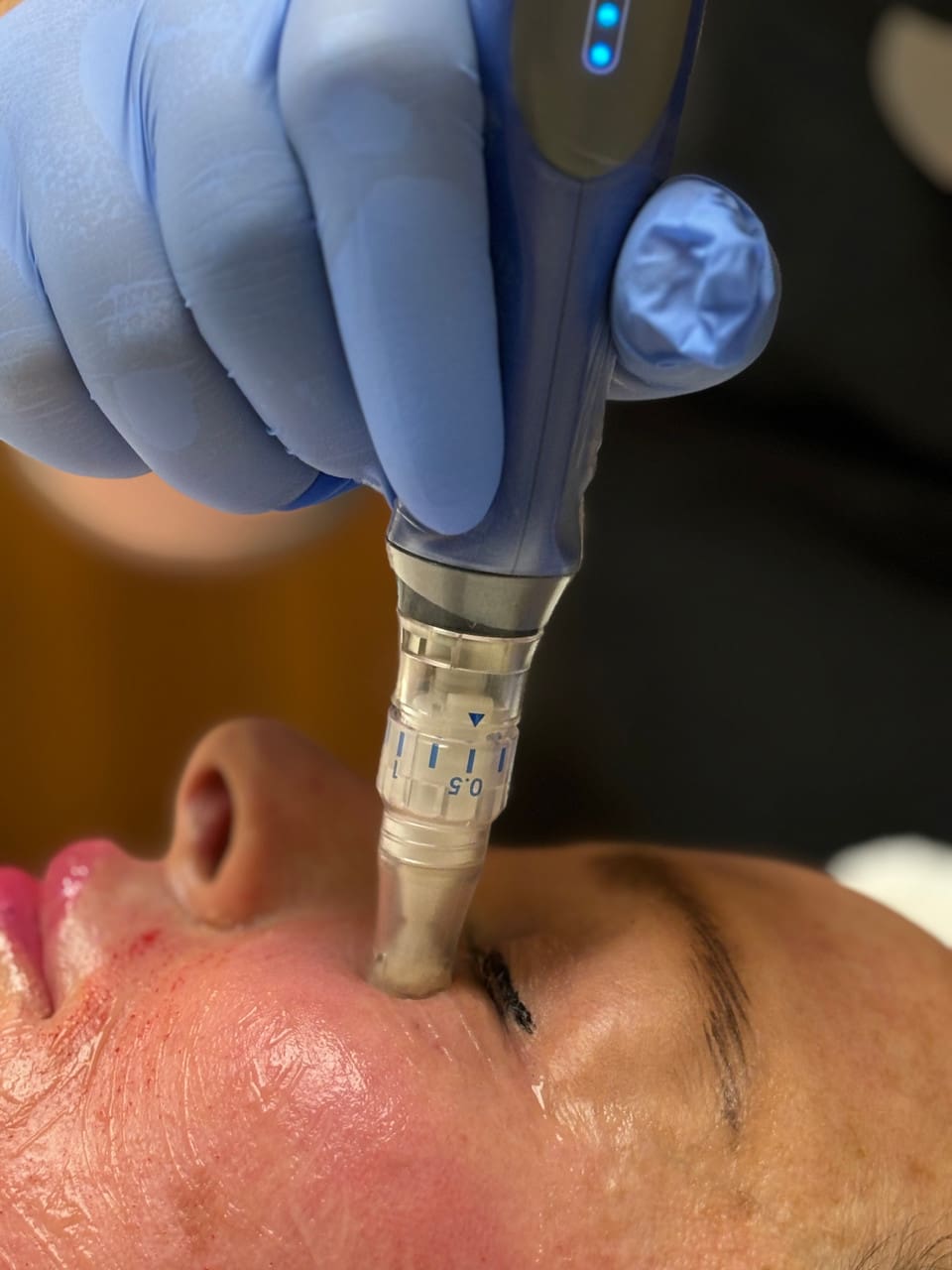 products microneedling 65200 1729864894 1280 1280 jpg