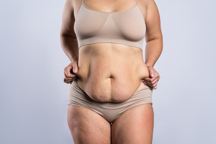 Excess Skin removal surgery tummy tuck abdominoplasty board-certified plastic surgeons Mishawaka, IN
